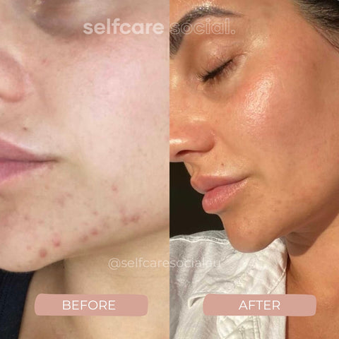 Ultimate Selfcare Bundle: LED Mask, Face Mask, Eye Mask, Clip & Scalp Scrubber