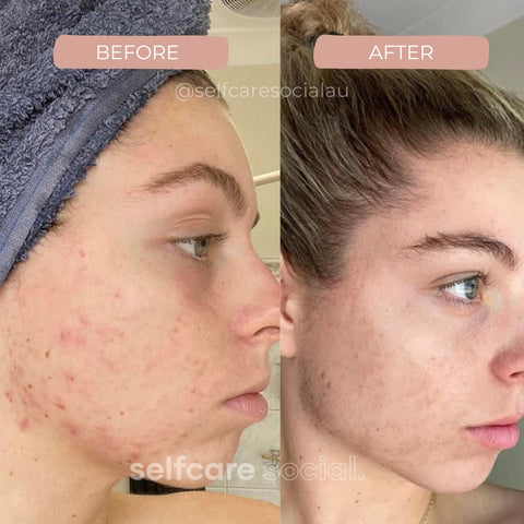 Youthful Glow Duo - LED Mask & Hydrating Eye Masks