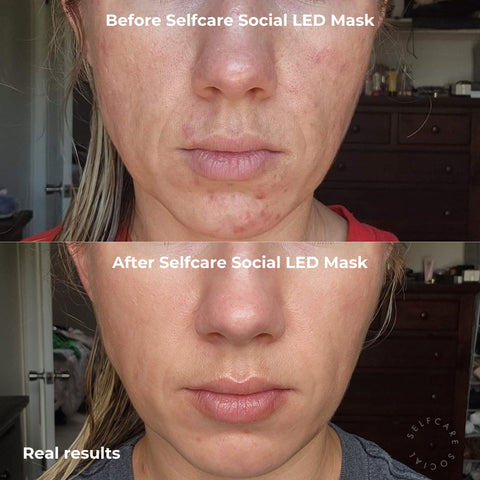 Before and After Selfcare Social LED Mask