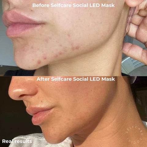 Social Skin 3-in-1 LED Light Therapy Face Mask
