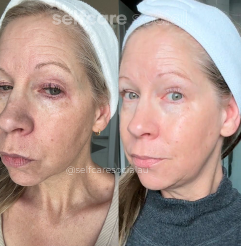 Before and after comparison SELFCARE SOCIAL LED MASK SOCIAL SKIN LED