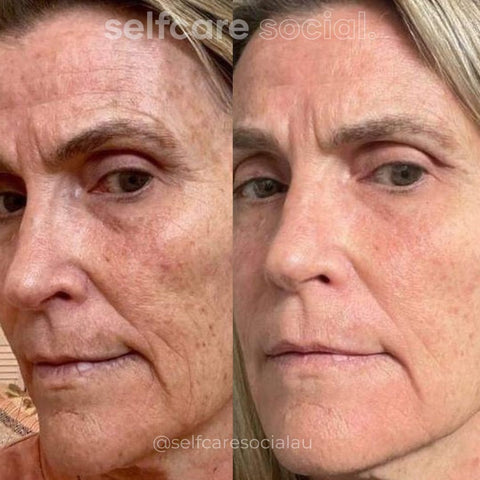 Before and After Selfcare Social LED Mask