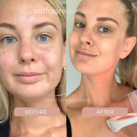 Youthful Glow Duo - LED Mask & Hydrating Eye Masks