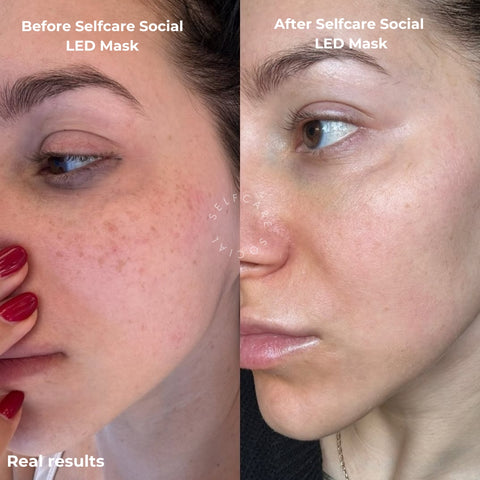 **PRE-ORDER** Social Skin 3-in-1 LED Light Therapy Face Mask