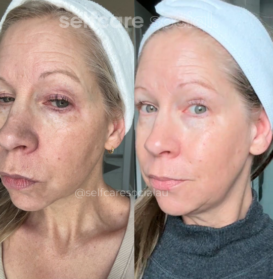 Before and after comparison SELFCARE SOCIAL LED MASK SOCIAL SKIN LED
