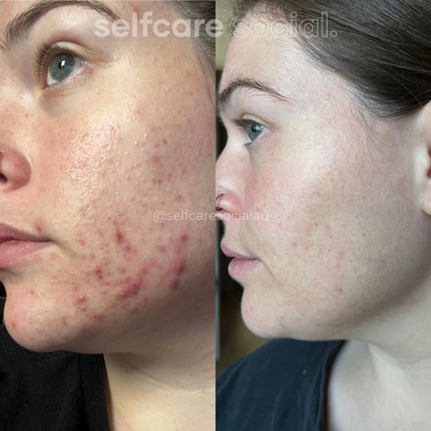 Radiance Glow Duo - LED Mask & Collagen Face Masks