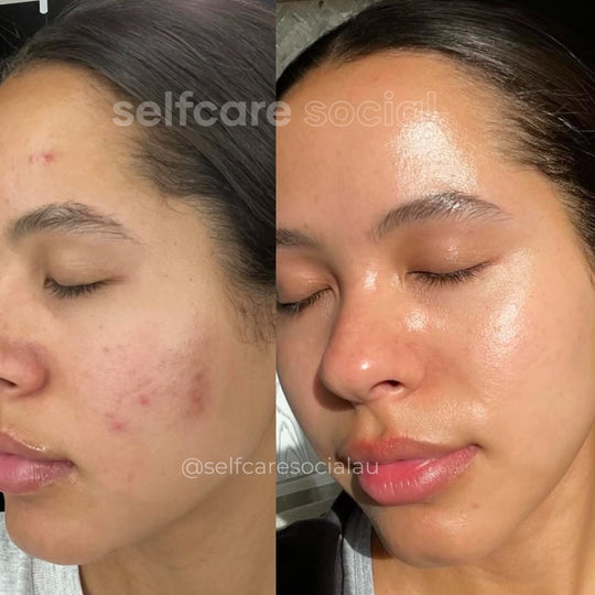 Before and After Selfcare Social LED Mask - Social Skin LED Mask
