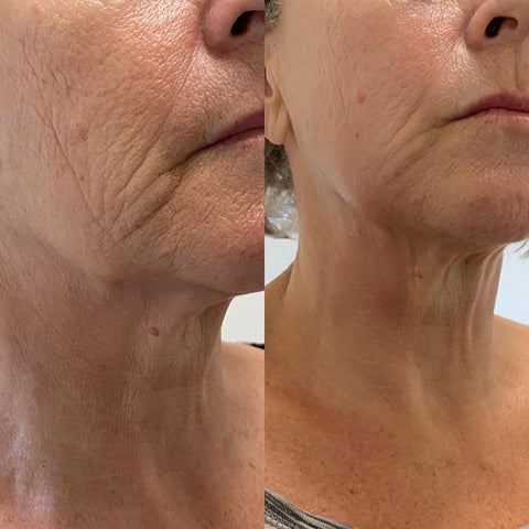 Face & Neck Tech Duo - LED Mask & GlowLift Wand Face and Neck Device